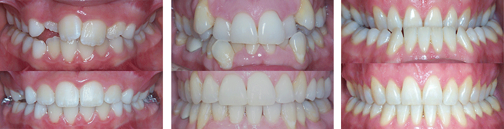 Children s Braces in Solana Beach