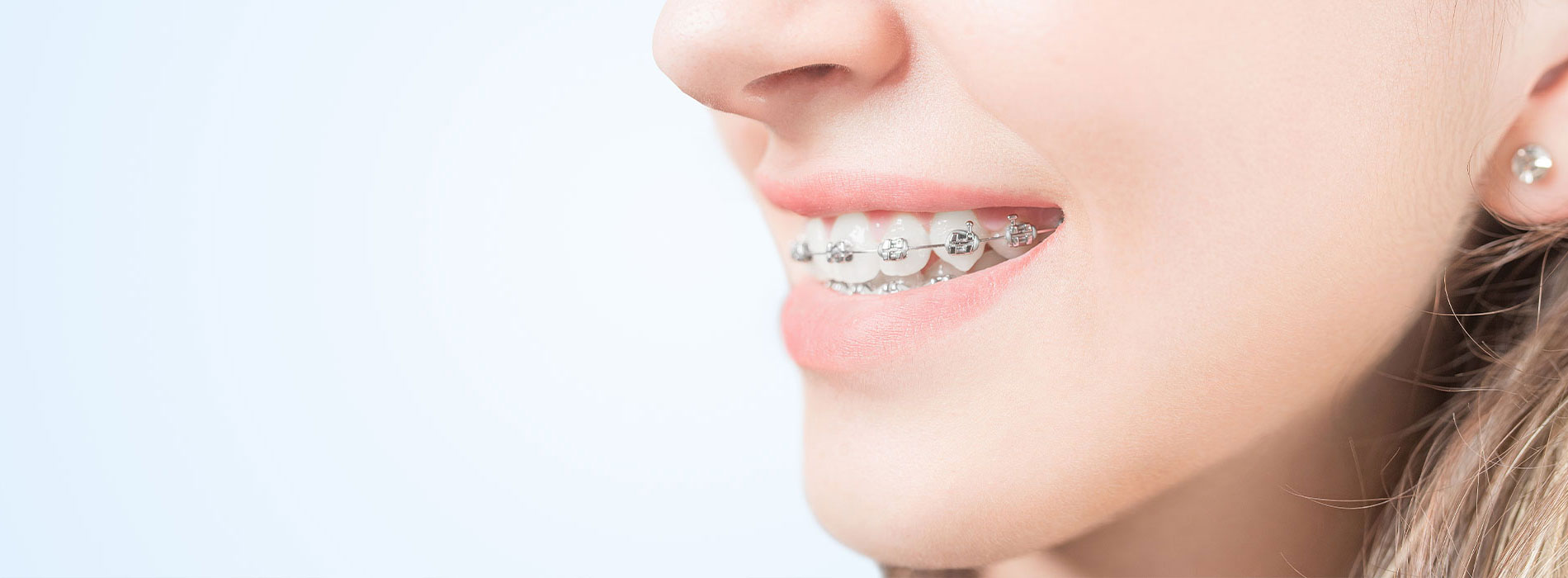 Children s Braces in Solana Beach